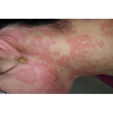 久金 荨麻疹丸 10gx6袋/盒 吉林龙鑫药业有限公司