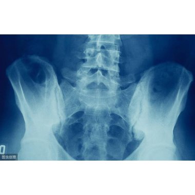 益赛普 注射用重组人Ⅱ型肿瘤坏死因子受体-抗体融合蛋白