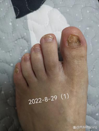 优选 盐酸阿莫罗芬搽剂