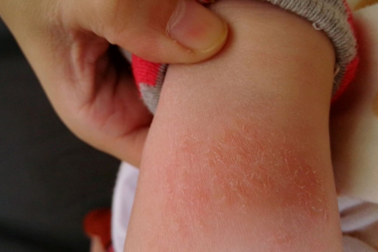 优选 宝宝湿疹膏