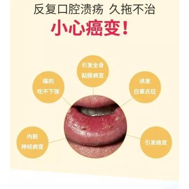 口腔溃疡含片