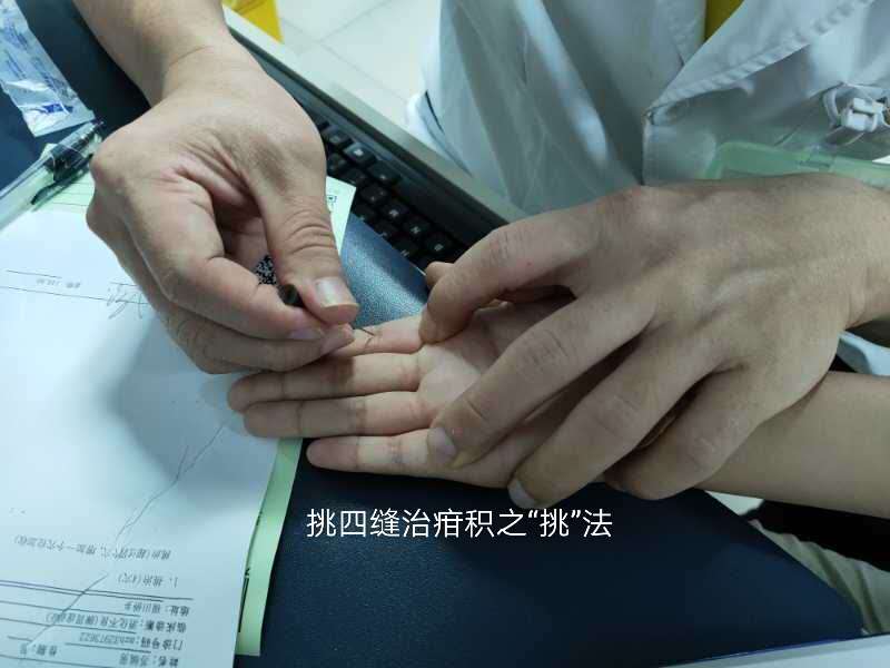 优选 小儿疳积糖（笑谊