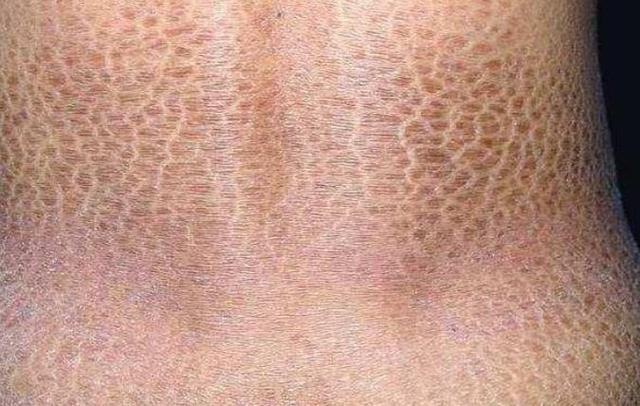 优选 鱼鳞病片（套盒）