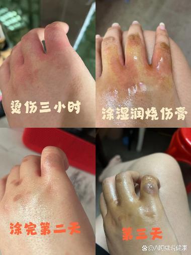 优选 湿润烧伤膏(美宝